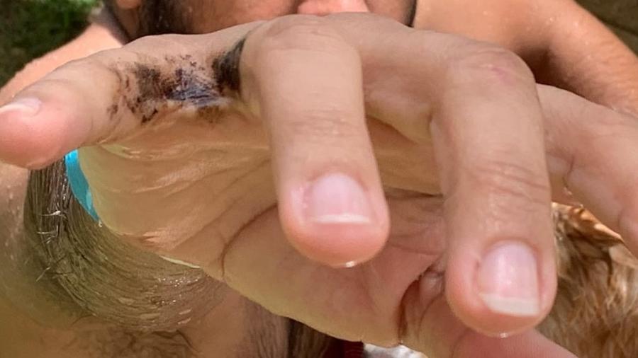 Óleo invisível deixa manchas em banhistas que frequentam praias no Nordeste